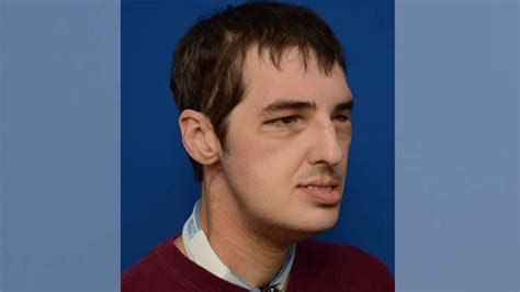 Man Who Received First Full Face Transplant Doing Great 7 Months After