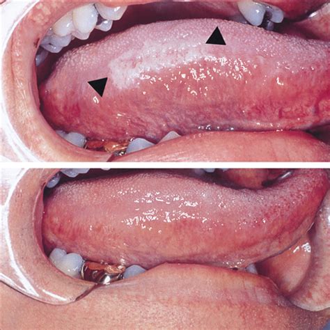 β Carotene Produces Sustained Remissions In Patients With Oral