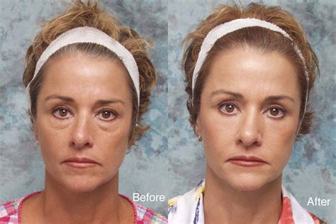She's only eaten a bit of a squeezie treat (the tube treats that look like. Blepharoplasty or Lower Eyelid Surgery: Risks & Recovery ...