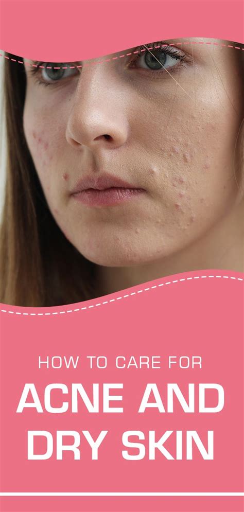 How To Care For Acne And Dry Skin Dry Skin On Face Dry Skin Acne