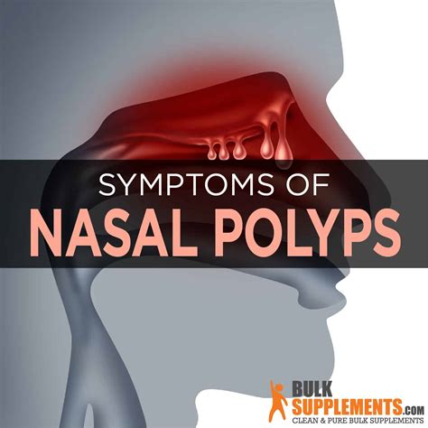 Nasal Polyps Symptoms Causes And Treatment By James Denlinger