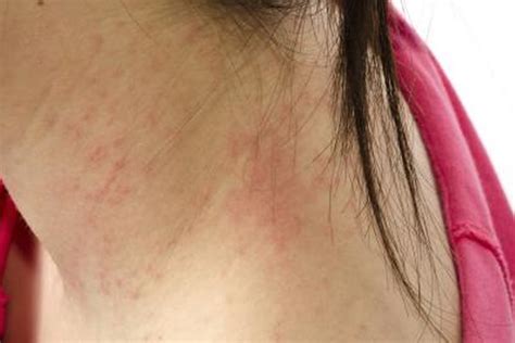 What Does Skin Shingles Look Like Healthy Living