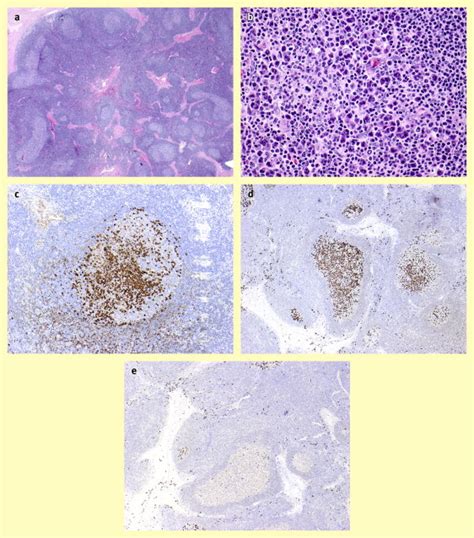 Igg4 Related Lymphadenopathy And Igg4 Related Lymphoma Moving Targets Diagnostic Histopathology