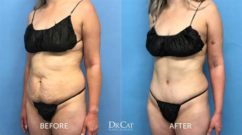 Tummy Tuck Surgery Week By Week Recovery Timeline Dr Cat
