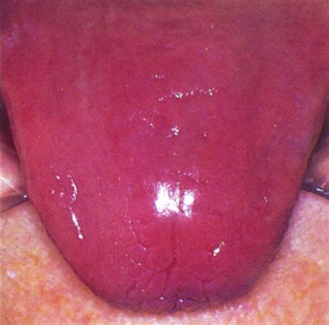 Pernicious Anemia - Causes, Signs, Symptoms, Treatment