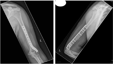 Figure From Distal Third Humeri Fractures Treated Using The Synthes Mm Extra Articular