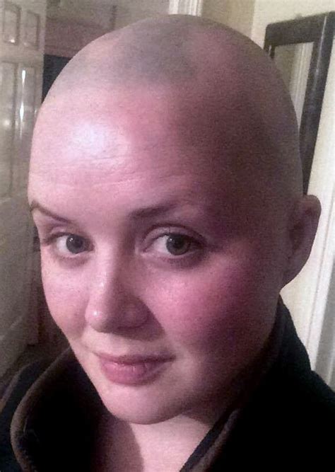 brave alopecia sufferer shaves head after documenting hair loss journey with inspiring photos