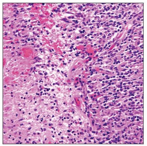 Extranodal Nk T Cell Lymphoma Nasal Type Basicmedical Key