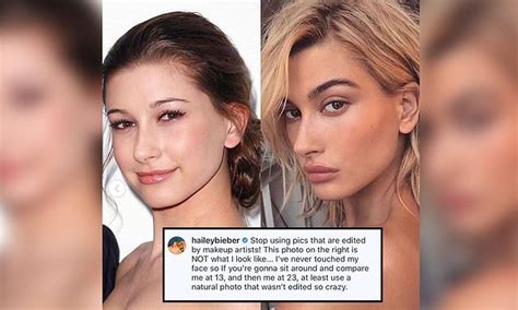 Hailey Bieber Slams Accusations That She Underwent Plastic Surgery I