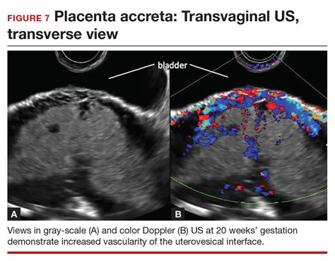 Placenta Increta Ultrasound Hot Sex Picture