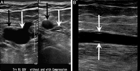 Its Not All Deep Vein Thrombosis Sonography Of The Painful Lower