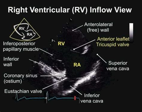 Right Ventricular Inflow View Tee Diagnostic Medical Sonography