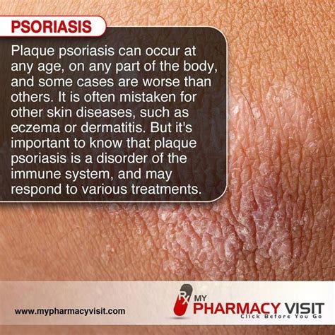 Pin On Plaque Psoriasis Treatment