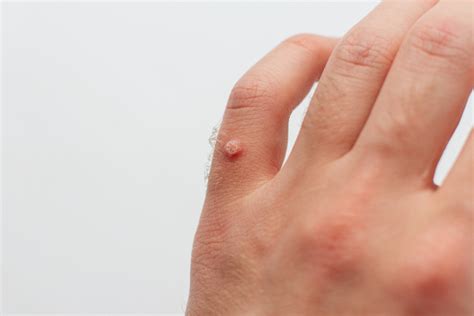 Warts 101 What You Need To Know About Warts And Wart Removal