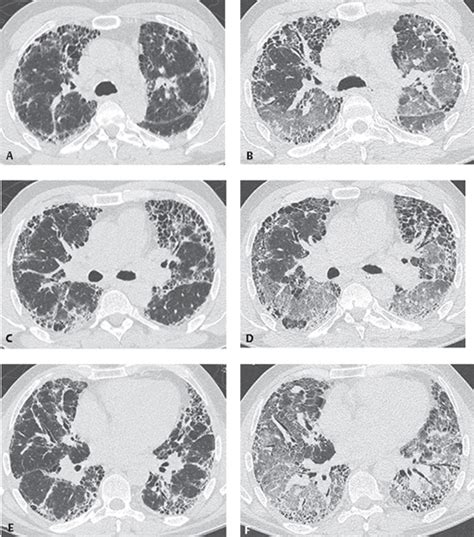 116 Usual Interstitial Pneumonia Uip Radiology Key