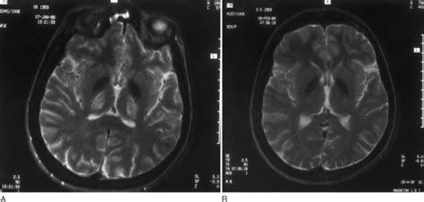 Wilson Disease Neupsy Key