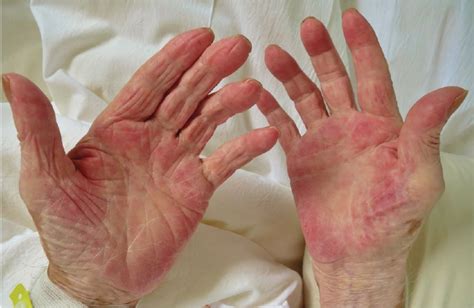 Palmar Erythema As A Sign Of Cancer Cleveland Clinic Journal Of Medicine