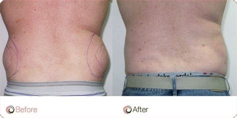 Male Back Vaser Lipo Gallery See Documented Results