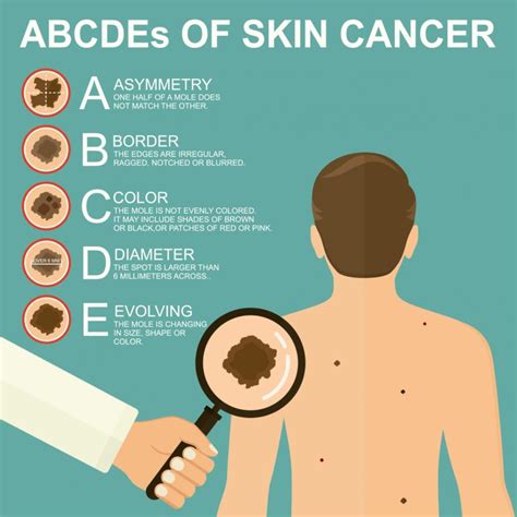About Skin Cancers Showground Skin Cancer