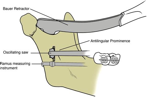 Intraoral Vertical Ramus Osteotomy Procedure And Technique Atlas Of