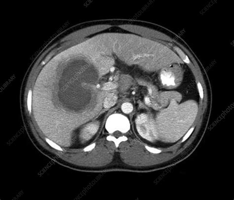 Liver Abscess Ct Scan Stock Image C0267955 Science Photo Library