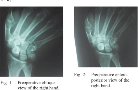 Figure 1 From Multiple Volar Carpometacarpal Dislocations With