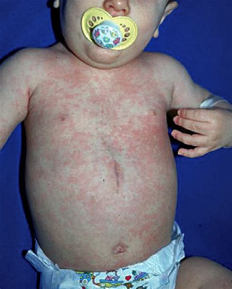 Roseola Rash Pictures Photos Images Causes Treatment 2018