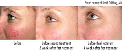 Red Spots And Rosacea Laser Genesis Treatment For Even Skin