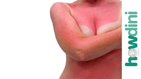 Quick Sunburn Relief Sunburn Treatment And Remedies Youtube