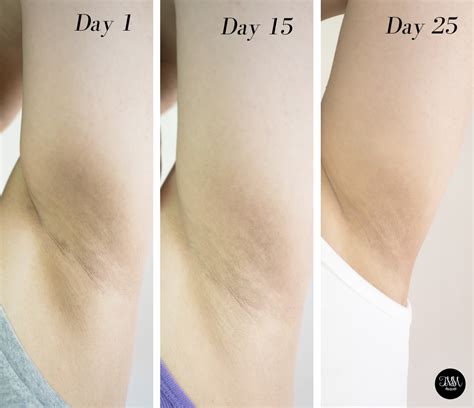 Find out the pros and cons between these two hair removal methods and choose which one fits into you simply have to decide which method fits into your lifestyle best. Triệt lông vĩnh viễn mấy lần, có mọc lại không, bao nhiêu ...