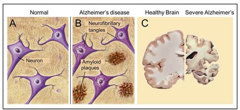 Major Pathological Hallmarks Of Ad Are Amyloid Plaques And