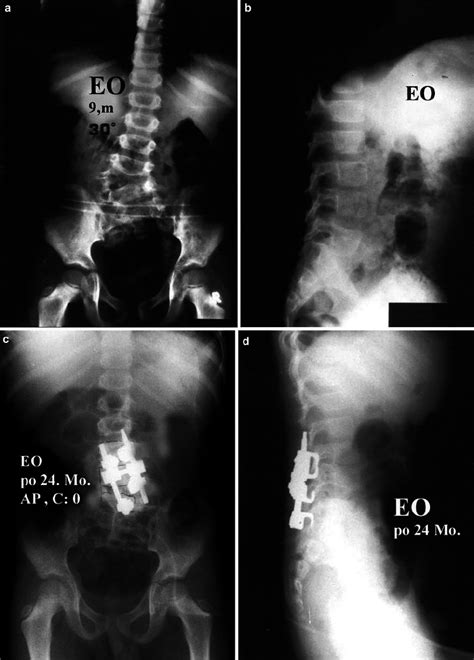 Eo 9 Year Old Male Patient With L3l4 Unincarcerated Fully Segmented