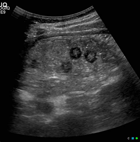 Grapes in stomach (ultrasound findings) | Image | Radiopaedia.org
