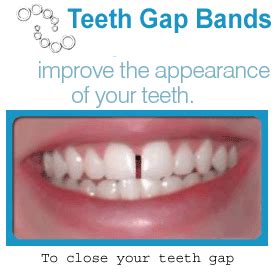 Nowadays there are also various ways to fix these dental gaps. Teeth Gap Bands - Close Gapped Teeth