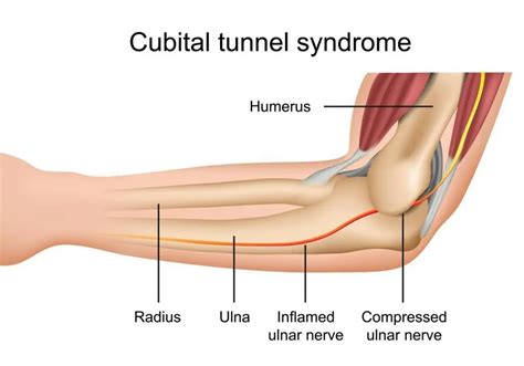 Bend your elbow (s) for long periods of time. Why Is My Pinky Finger Numb?