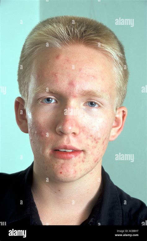 Portrait Blonde Teenage Boy With Acne On Face Stock Photo 7487318 Alamy