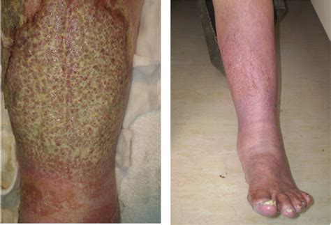 Diabetes Dry Skin On Legs Help Health
