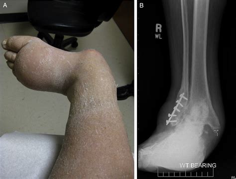 Combined Internal And External Fixation For Diabetic Charcot