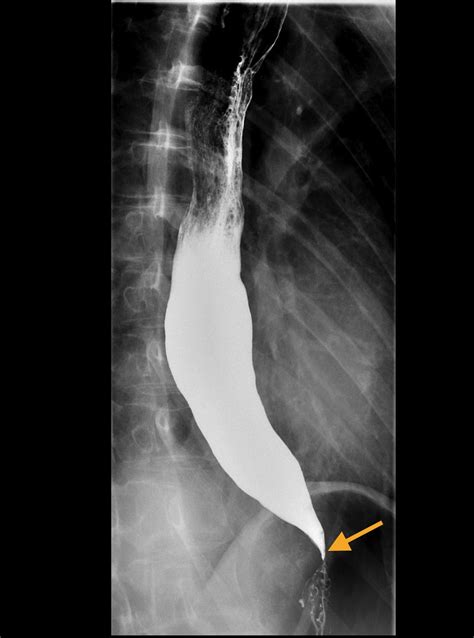 Achalasia Barium Swallow Radiology At St Vincents University Hospital