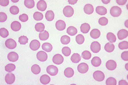 What causes elevated platelet counts in dogs? Thrombocytopenia in dog | eClinpath