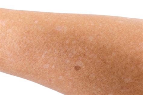 White Spots On Skin What Are They And Are They Dangerous