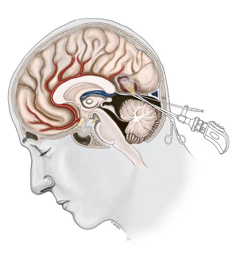 Minimally Invasive Brain Surgery Keyhole Craniotomy Brain Tumor Center