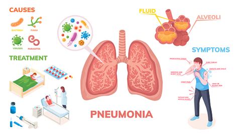 Pneumonia Lungs Disease Vector Infographics On Symptoms Cause And