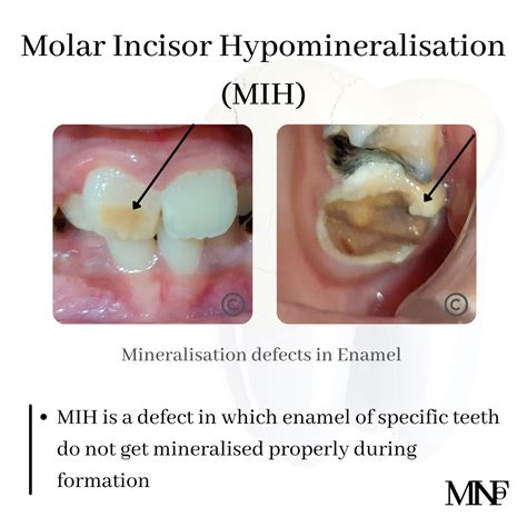 Molar Incisor Hypomineralisation Mih Smile Specialists