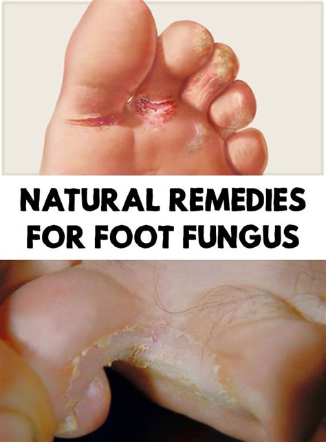 There Are Not Many People That Admit That They Have Foot Fungusthis