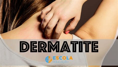 Dermatite O Que Causas Sintomas Tratamento Tipos