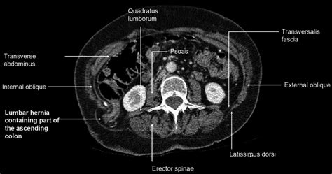 Transverse Slice Of Ct Abdomen Showing Ascending Colon In Hernial Sac