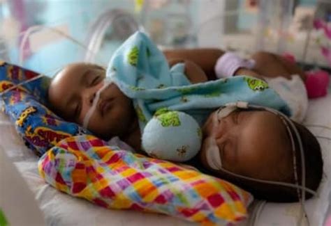 Conjoined Twins Separated In ‘historic 11 Hour Surgery At Texas