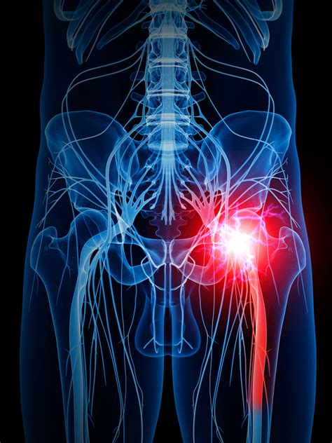 A Complete Overview of Sciatica Nerve Pain | Kamerlink Pain Institute