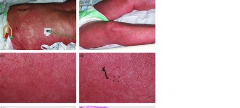 Clinical And Histological Features Skin Rash On Both Body A And Legs